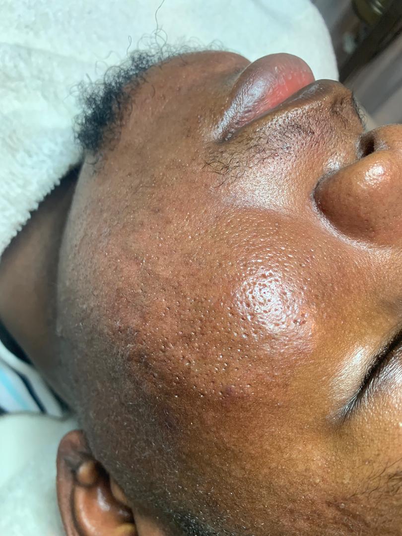 After Facial Treatment